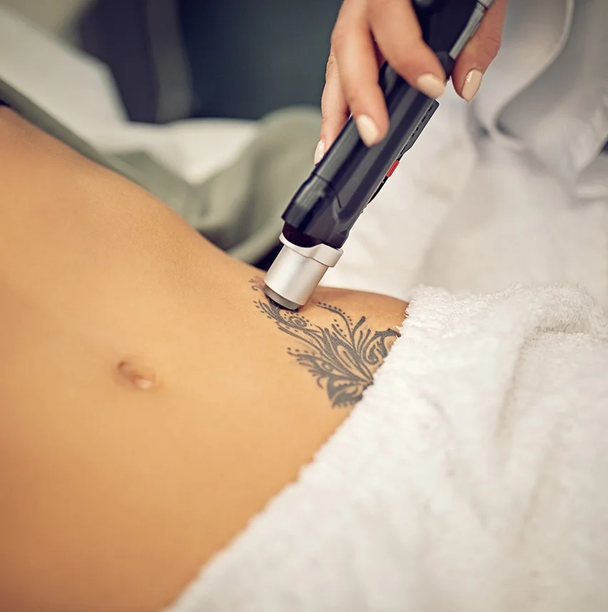 Close up of a laser tattoo removal tool | Tattoo Removal | NYC