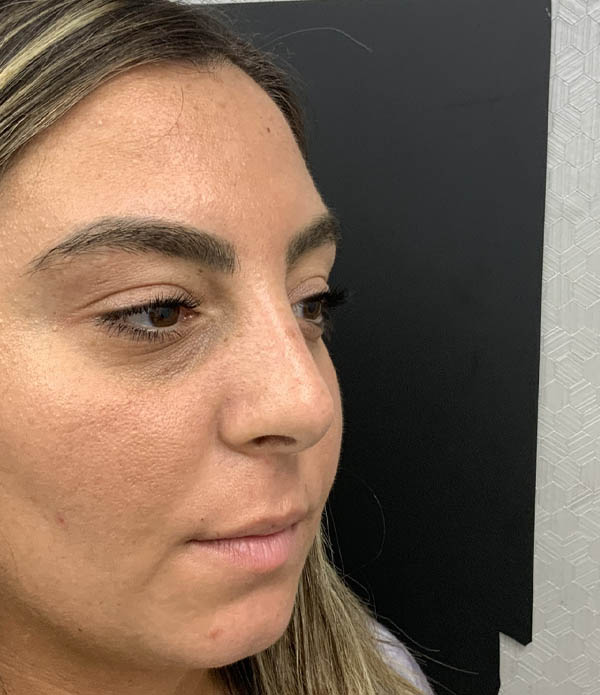 Rhinoplasty