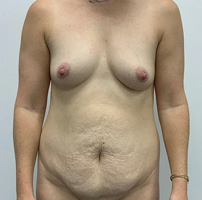 Tummy Tuck