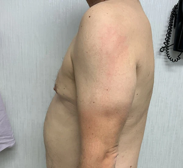 Gynecomastia