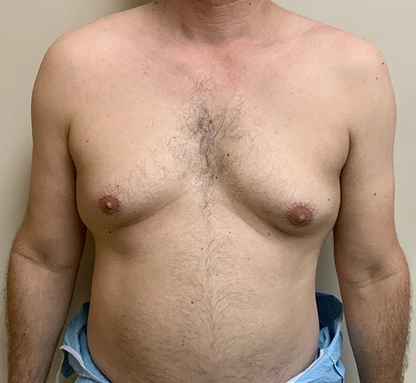 Gynecomastia