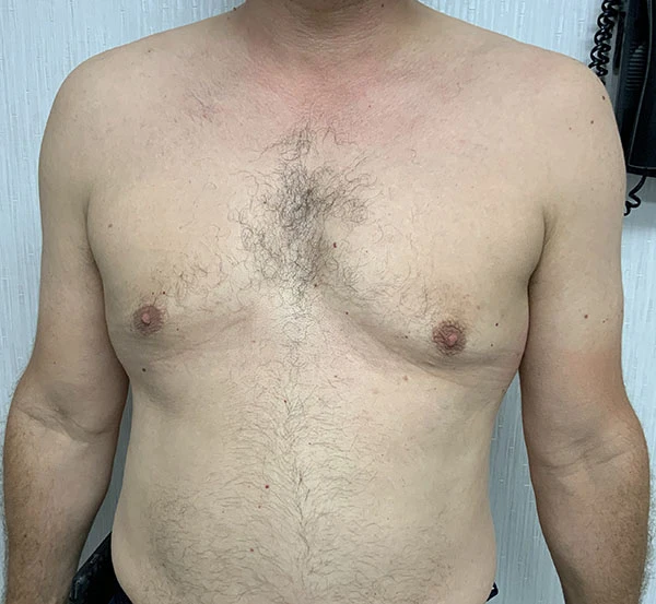 Gynecomastia