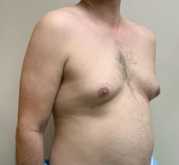 Gynecomastia