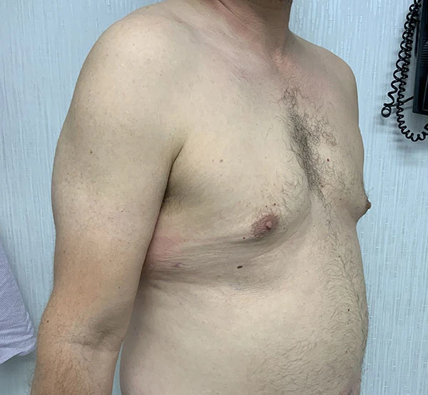 Gynecomastia