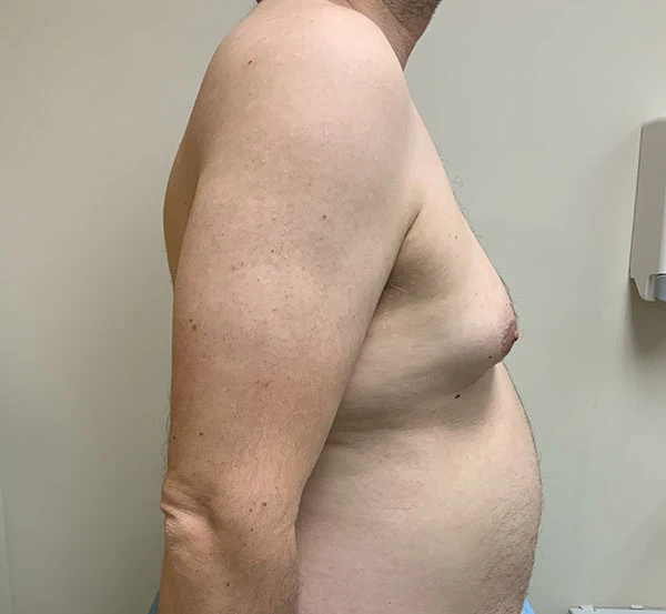 Gynecomastia