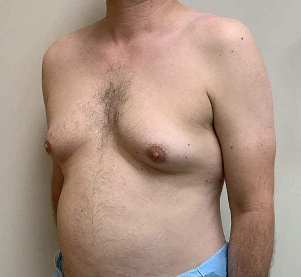 Gynecomastia