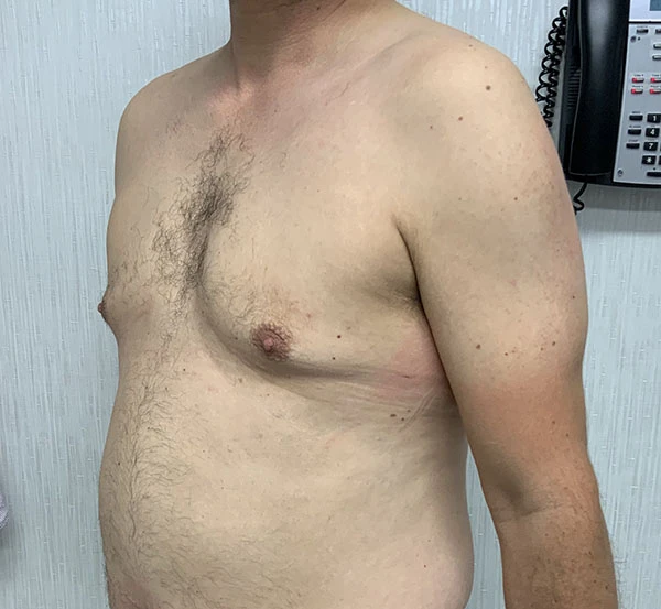 Gynecomastia