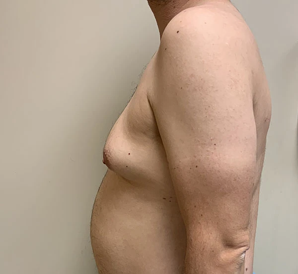 Gynecomastia