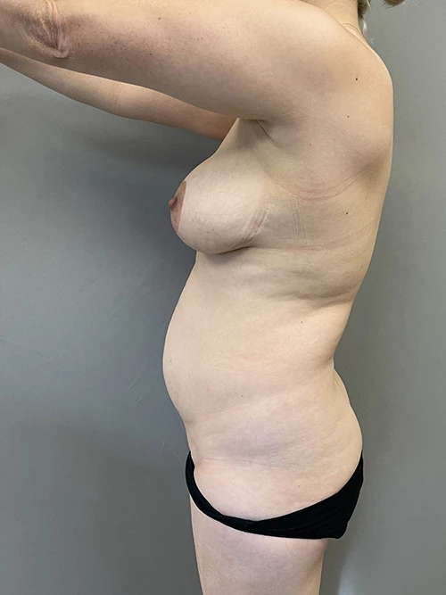 Breast Lift