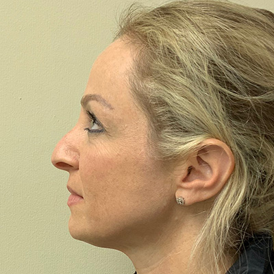 Liquid Rhinoplasty