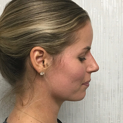 Liquid Rhinoplasty