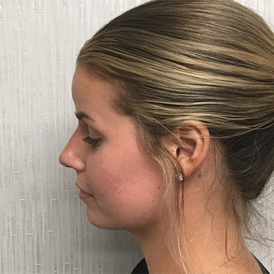 Liquid Rhinoplasty