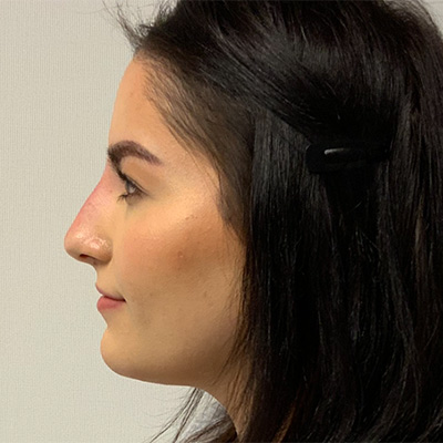 Liquid Rhinoplasty