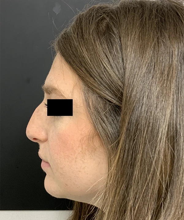 Rhinoplasty