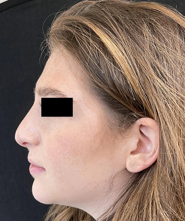 Rhinoplasty