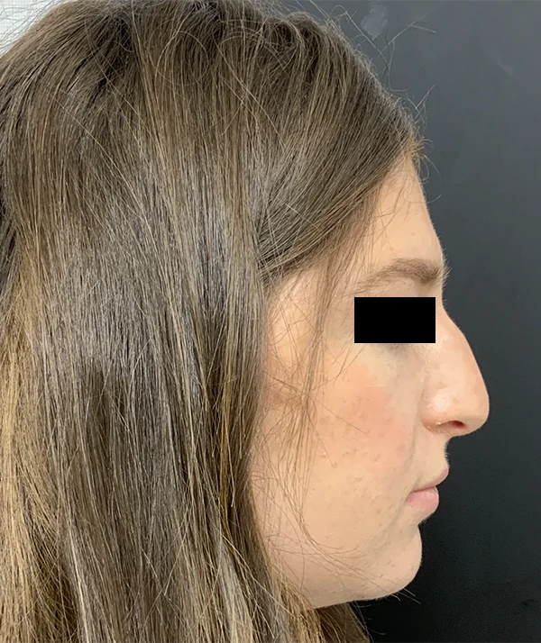 Rhinoplasty