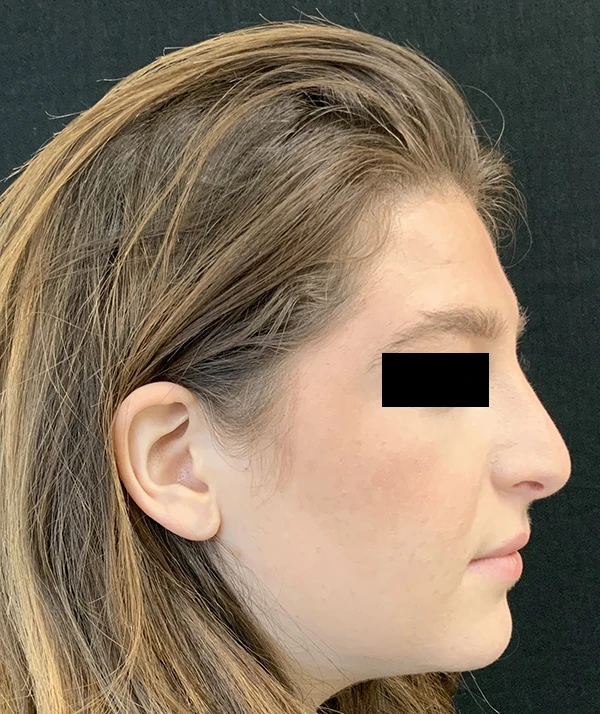 Rhinoplasty