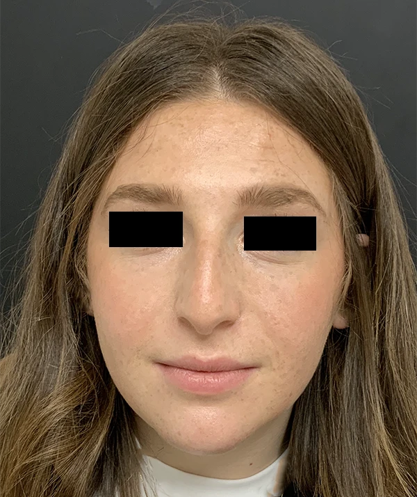 Rhinoplasty