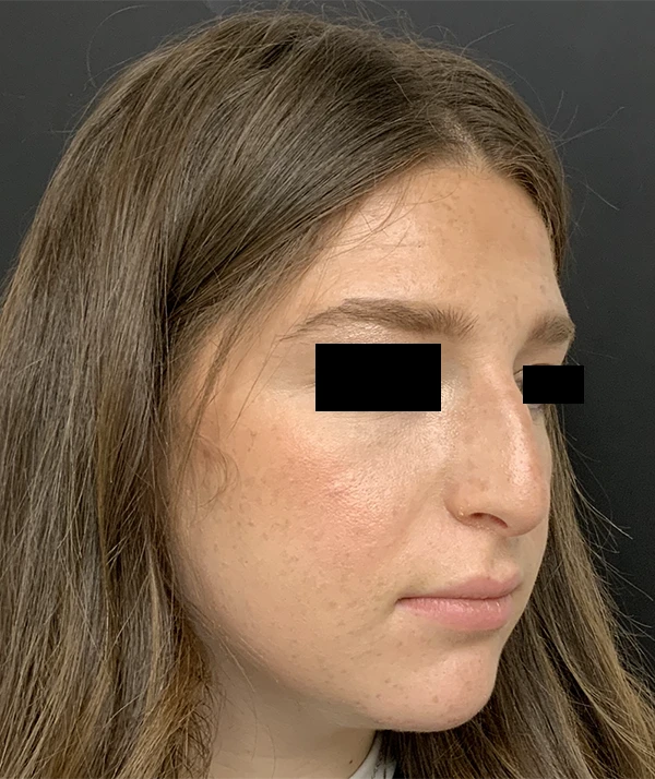 Rhinoplasty