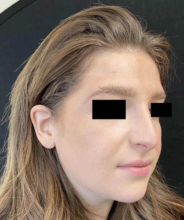 Rhinoplasty