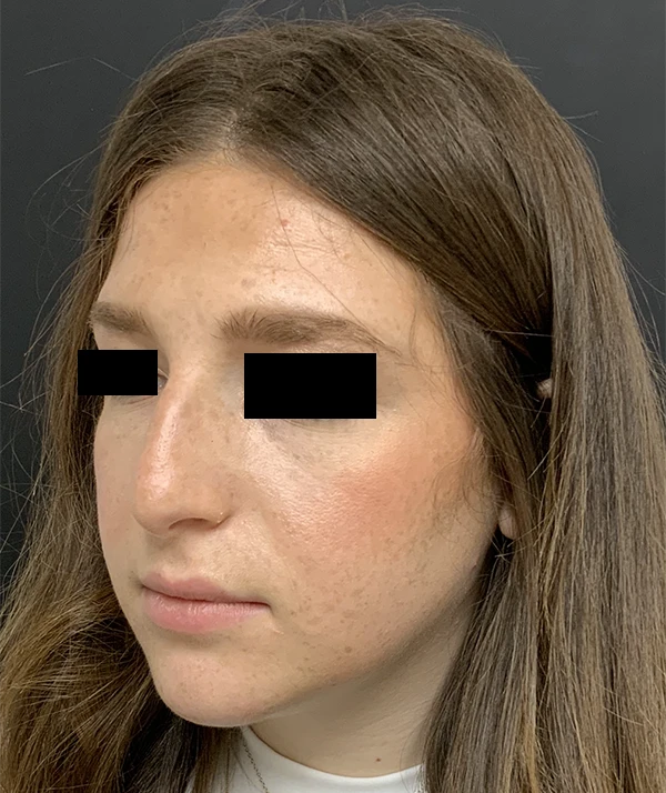 Rhinoplasty