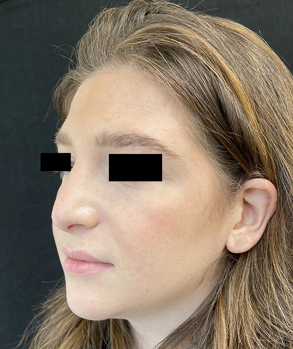 Rhinoplasty