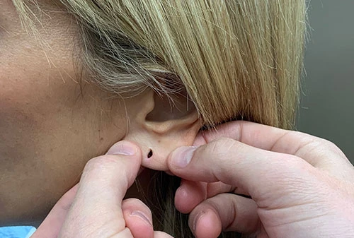 Earlobe Repair