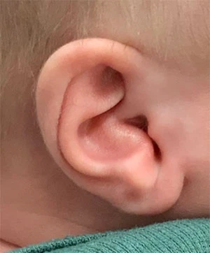 Ear Molding