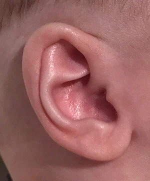 Ear Molding