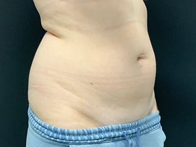 Liposuction