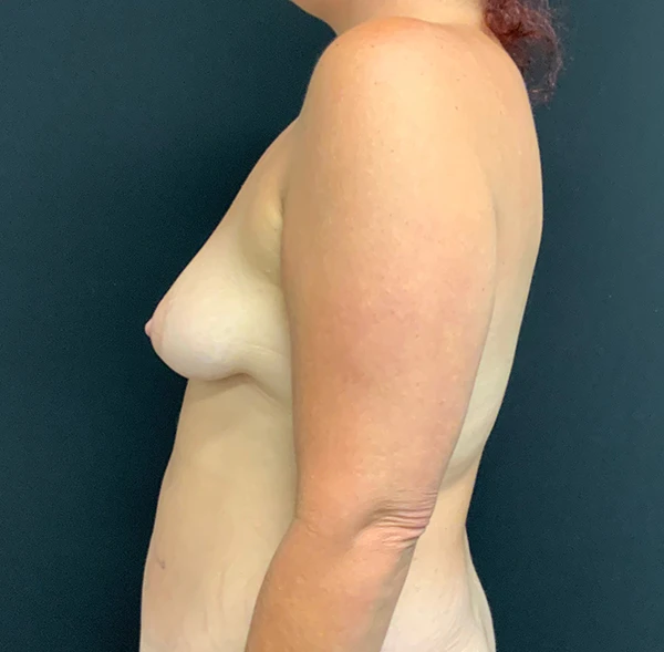 Breast Augmentation with Lift