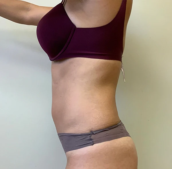 Tummy Tuck