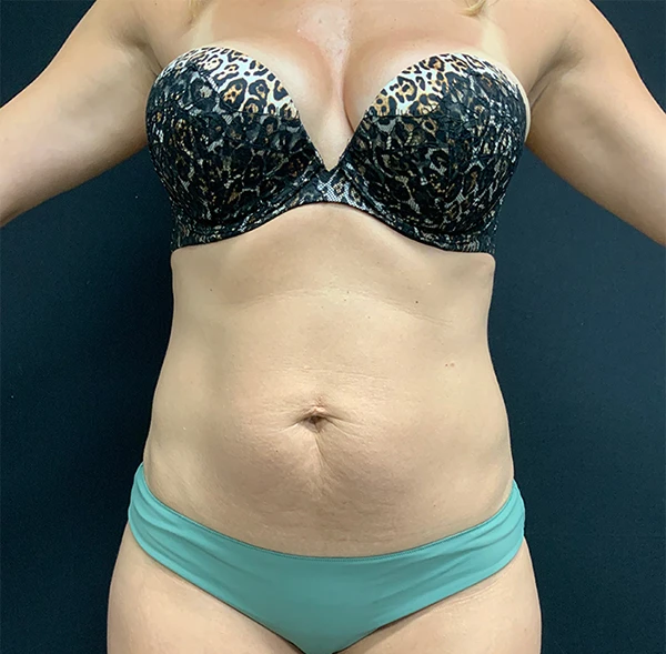 Tummy Tuck