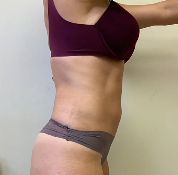 Tummy Tuck