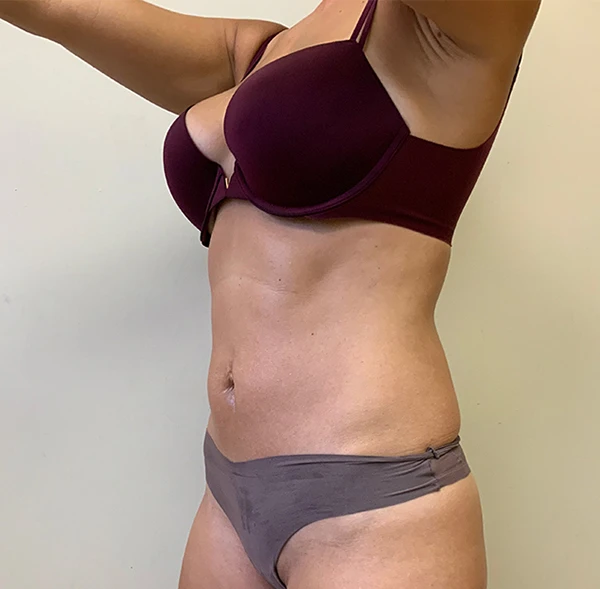 Tummy Tuck