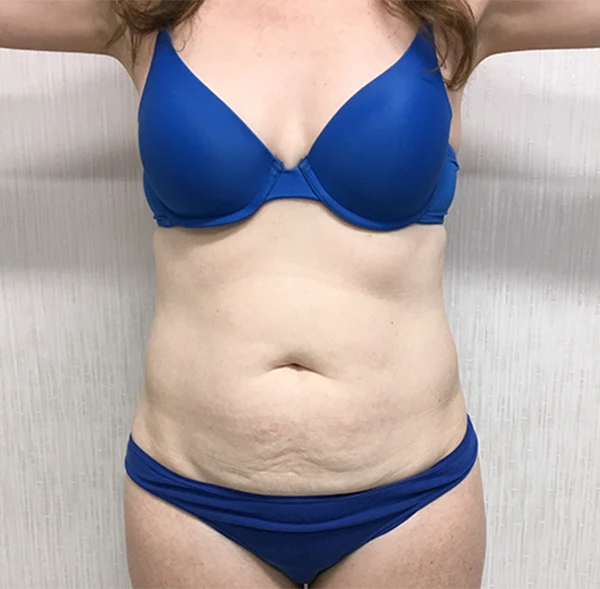 Tummy Tuck