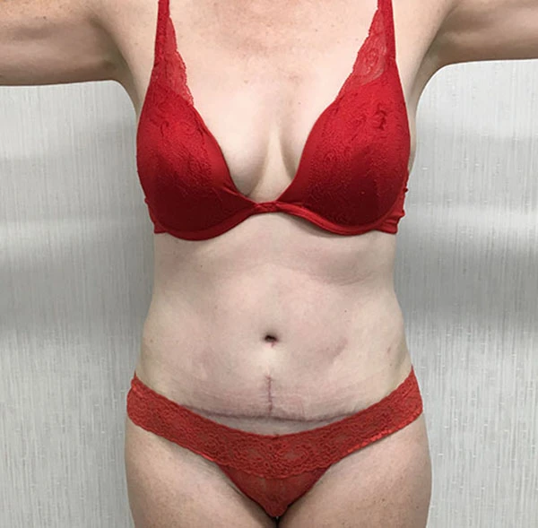 Tummy Tuck