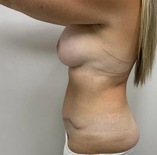 Tummy Tuck