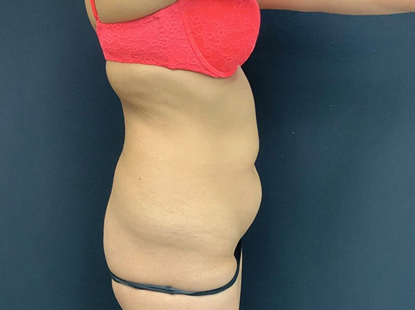 Liposuction