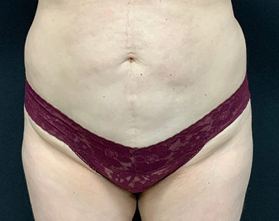 Liposuction