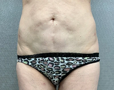 Liposuction