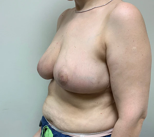 Breast Reduction