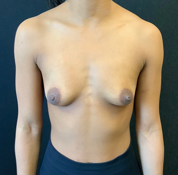 Breast Augmentation