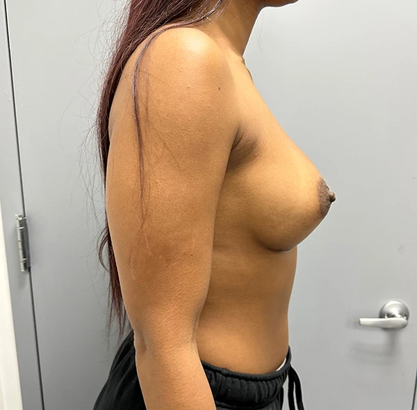 Breast Augmentation