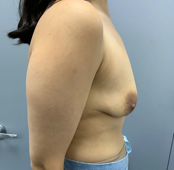 Breast Augmentation with Lift