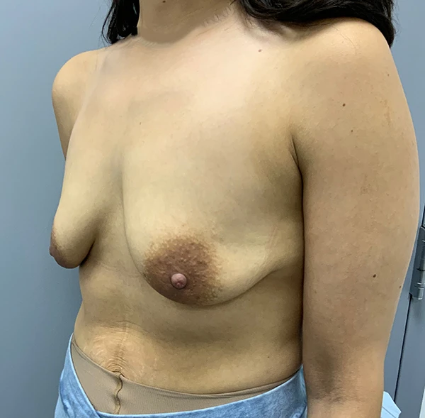 Breast Augmentation with Lift