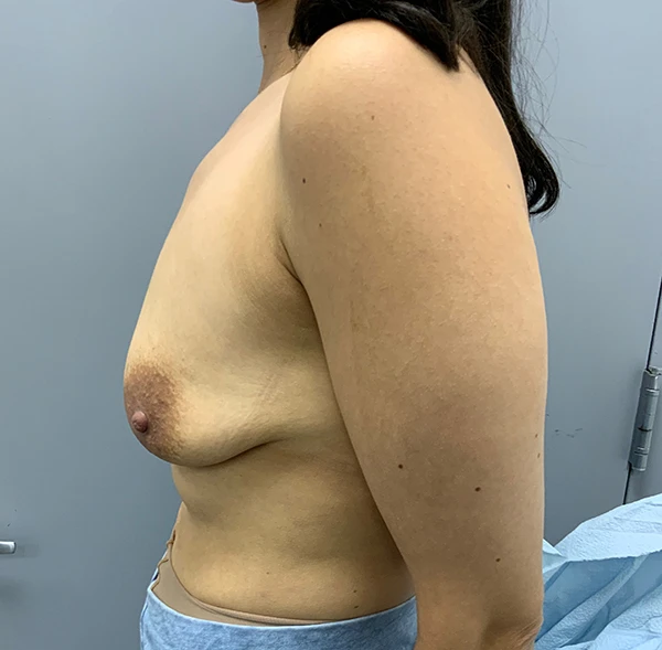 Breast Augmentation with Lift