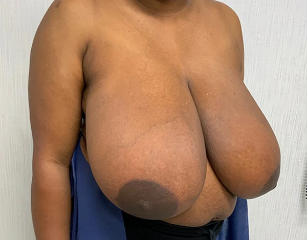 Breast Reduction