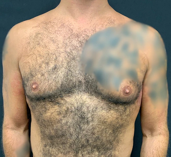 Gynecomastia