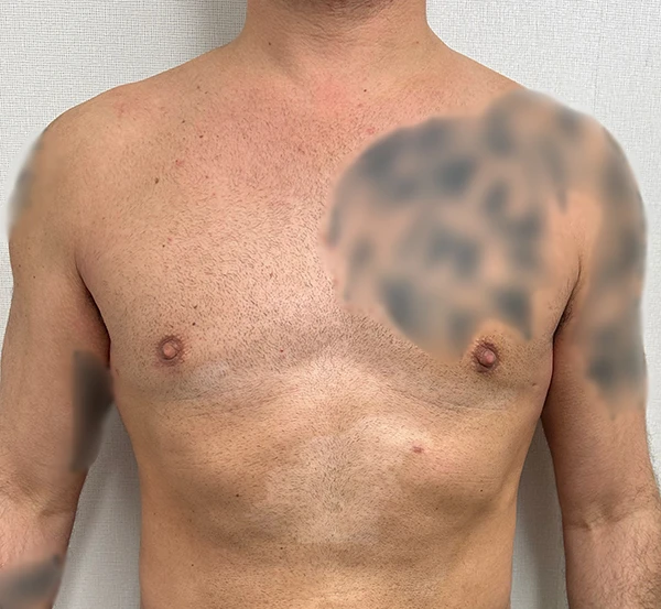 Gynecomastia